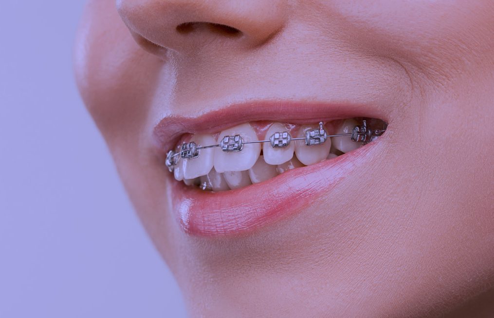 Todo lo que hay que saber de los brackets, tanto si ya tienes ortodoncia como si estás pensando llevarla